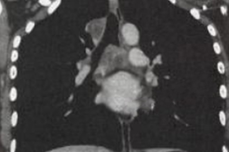 原发型肺结核CT表现图
