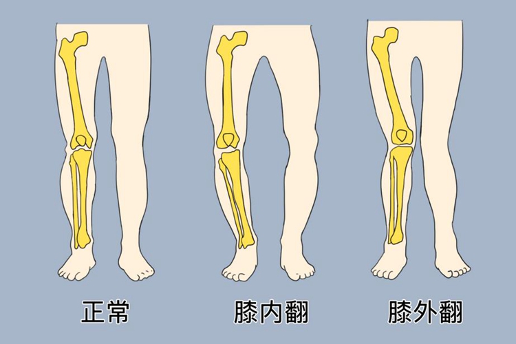 膝外翻鉴别图