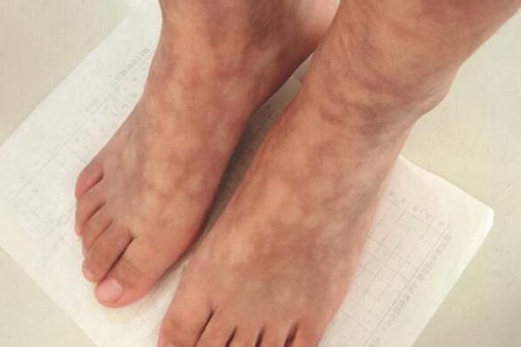 儿童结节性多动脉炎脚背条纹图