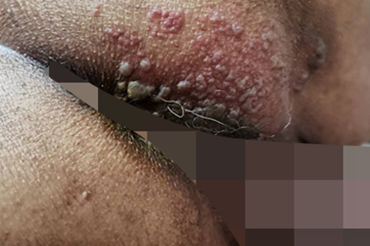 带状疱疹臀部出现水疱图