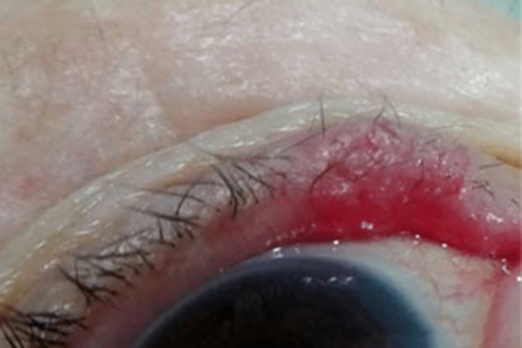 Merkel细胞癌眼睑症状图 Merkel细胞癌眼睑症状图