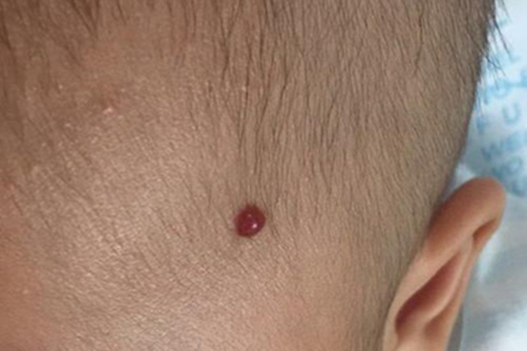 毛发肉芽肿长小红疙瘩图