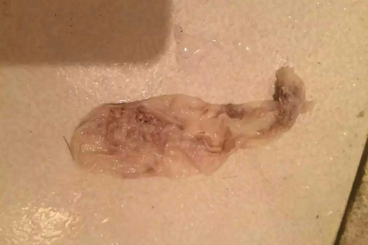 子宫排出白皮图