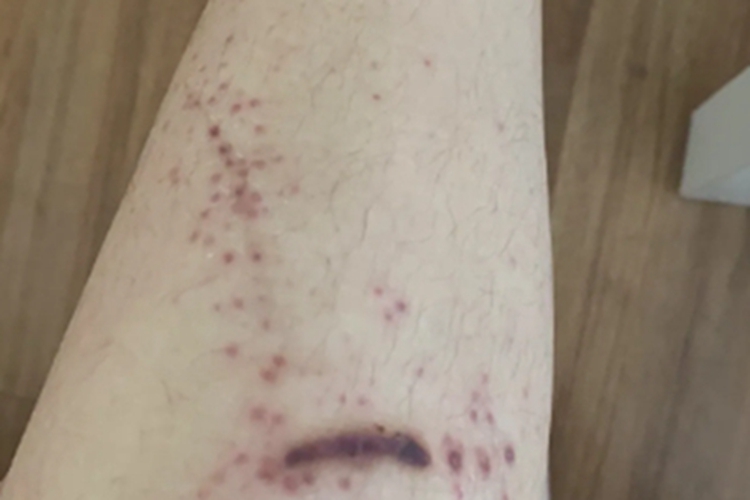 外科型猩红热小腿有一排红疹图 外科型猩红热小腿有一排红疹图