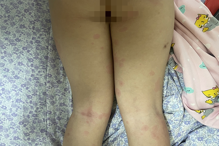 荨麻疹风团图 荨麻疹风团图