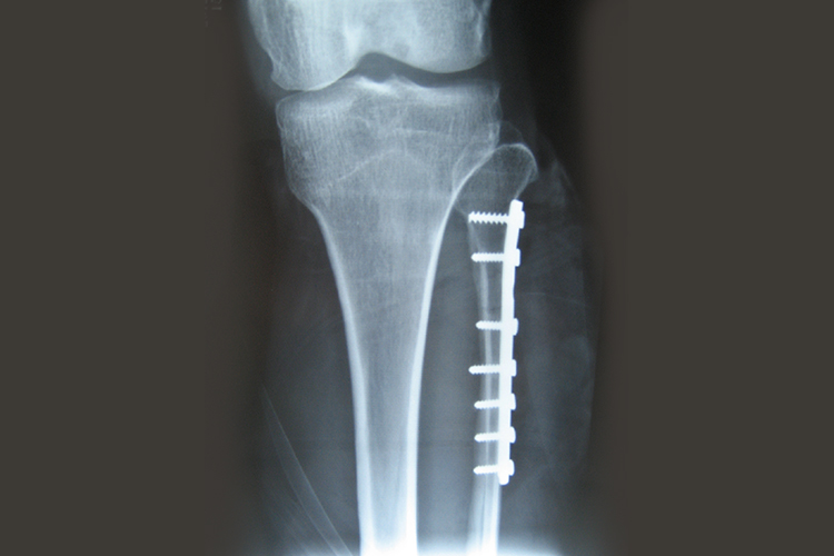 腓骨骨折钢钉图 腓骨骨折钢钉图