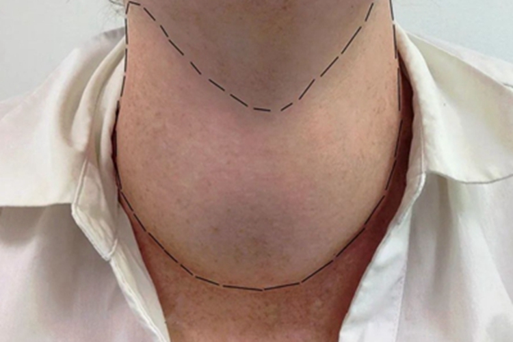 结节性甲状腺肿前颈肿块图 结节性甲状腺肿前颈肿块图