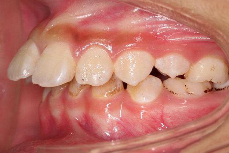 天包地牙齿矫正前后图片