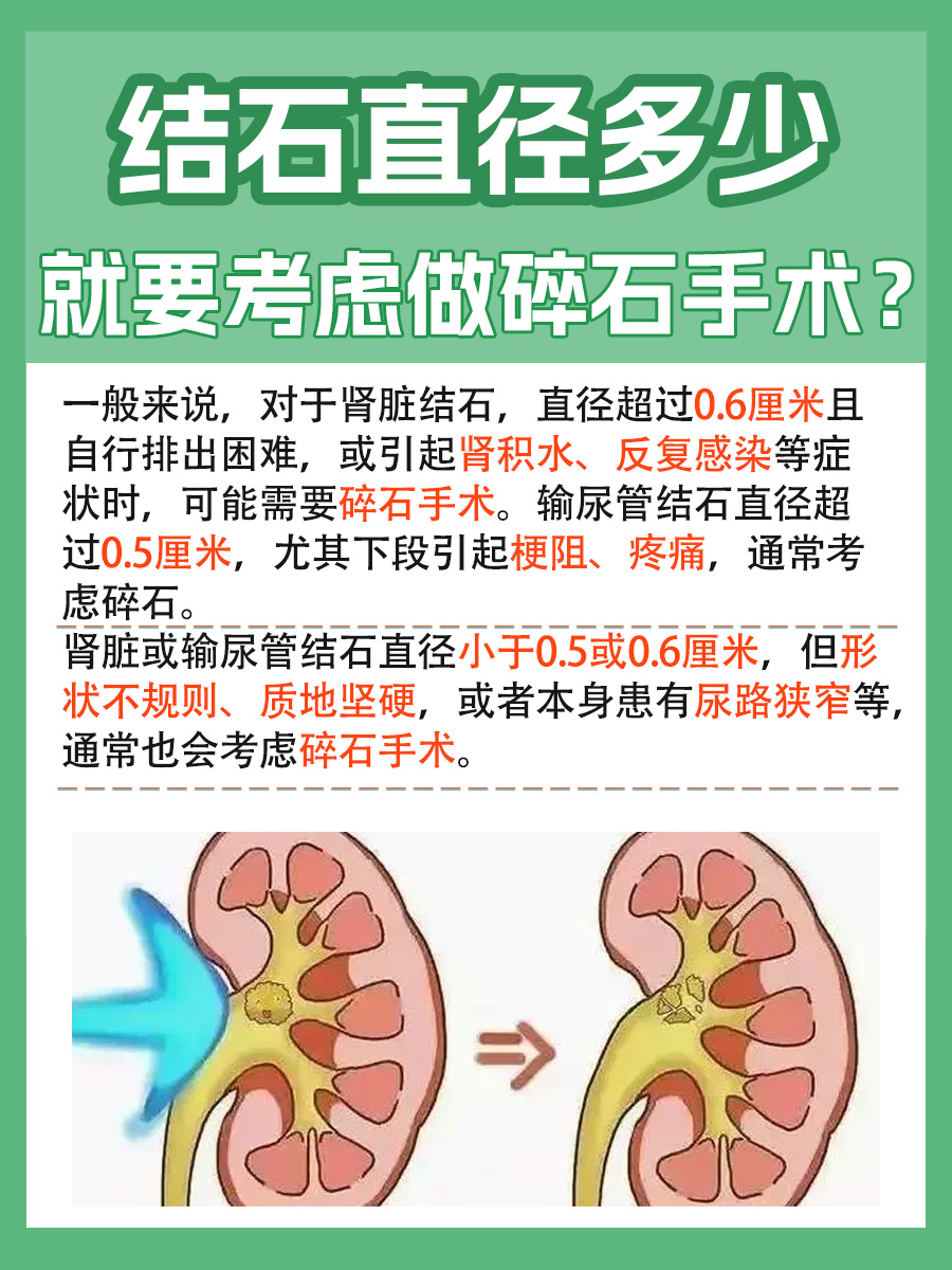 带你了解，结石多大需要做碎石手术