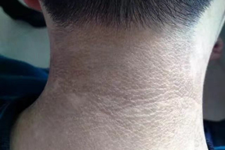 假性黑棘皮病后颈皮肤发黑图 假性黑棘皮病后颈皮肤发黑图