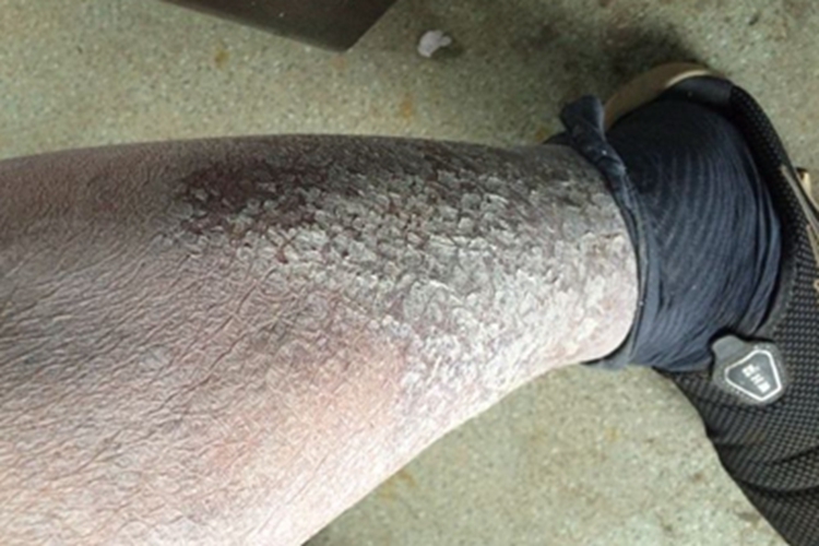 鱼鳞病小腿脱屑图