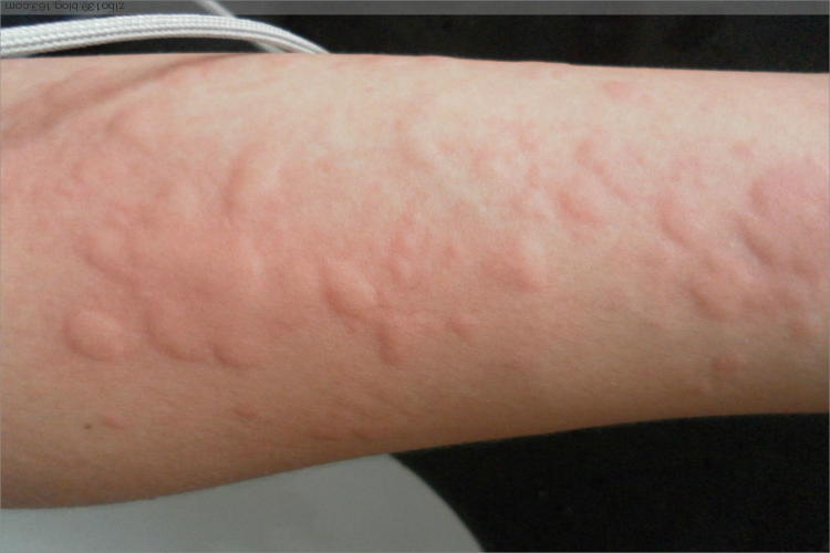 急性自发性荨麻疹风团图 急性自发性荨麻疹风团图