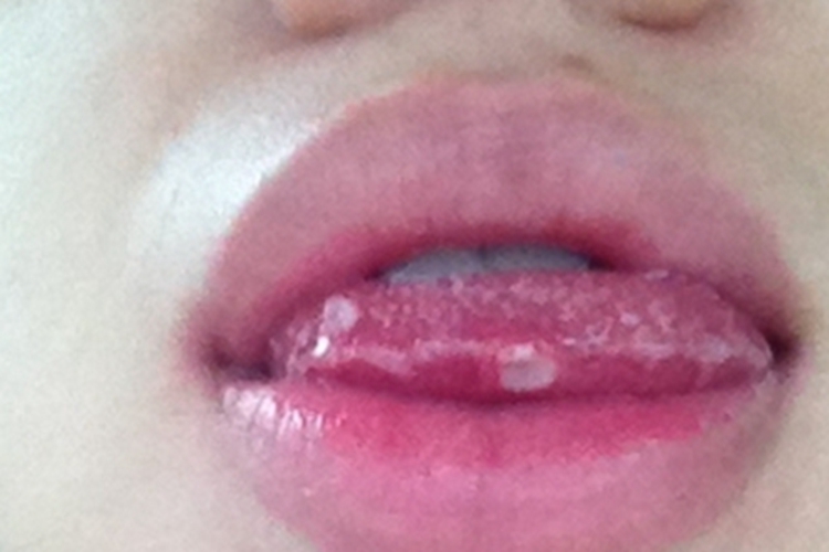 二期口腔梅毒舌头溃烂发白图