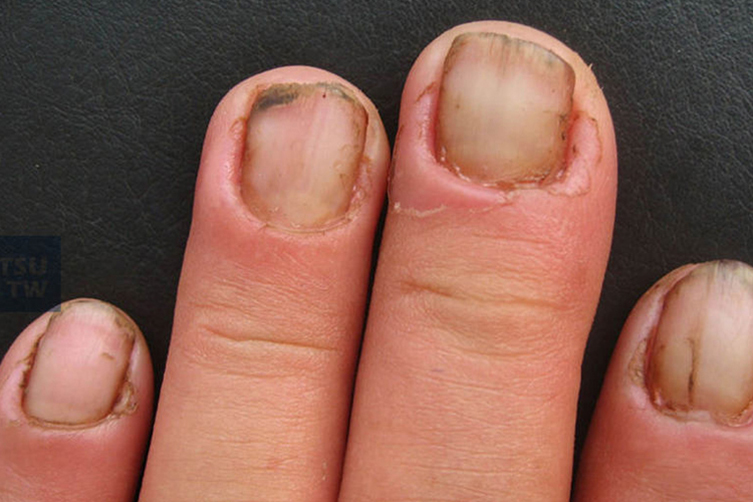 男性念珠菌性甲沟炎图