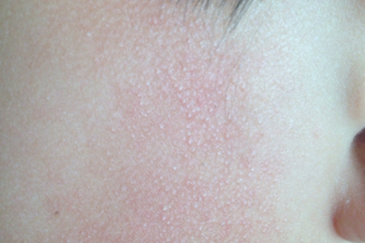 面部萎缩性毛周角化病症状图