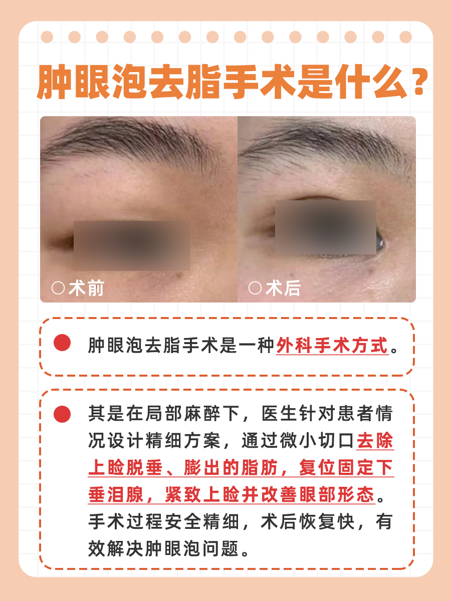 告别熊猫眼！医生揭秘肿眼泡去脂术，你了解吗？
