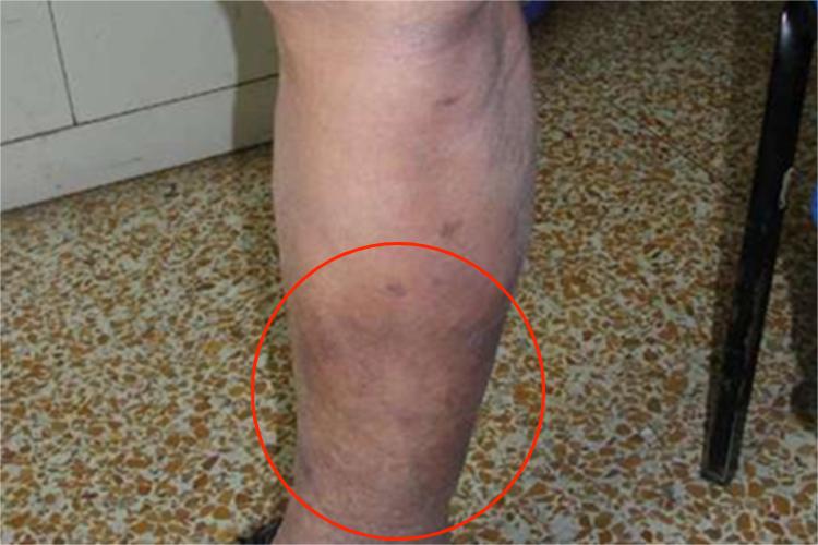 游走性血栓性浅静脉炎小腿肿块图 游走性血栓性浅静脉炎小腿肿块图