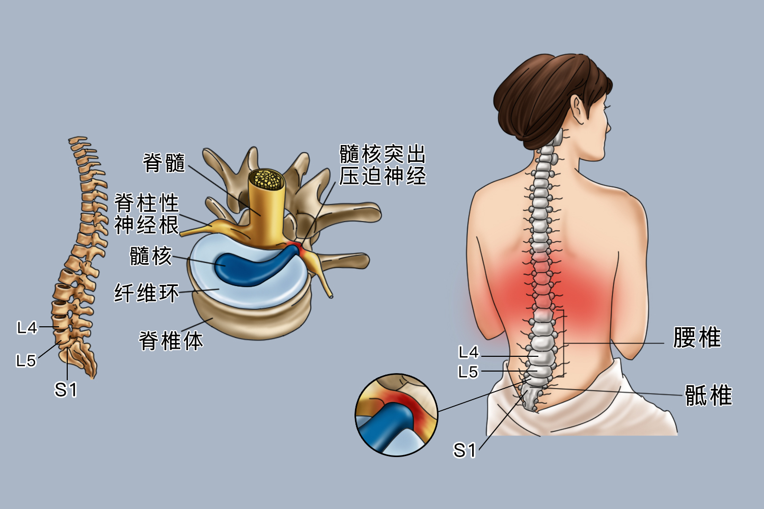 L4S1椎间盘突出位置图