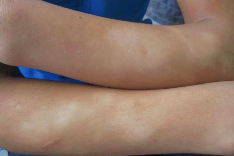 胳膊虫斑图