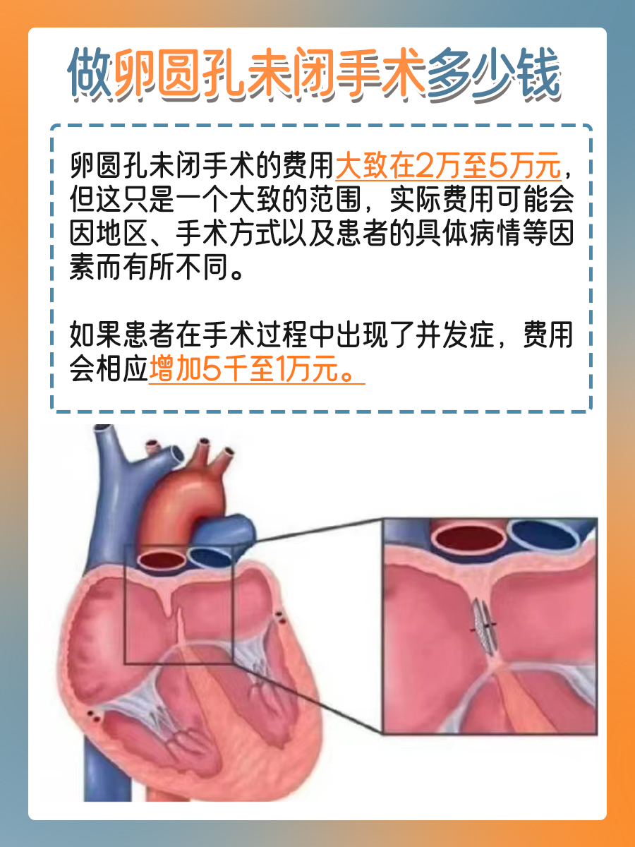 告别卵圆孔未闭，手术费用知多少？