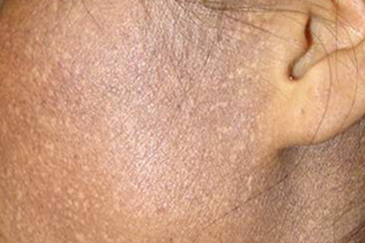 瑞尔黑变病面部症状图