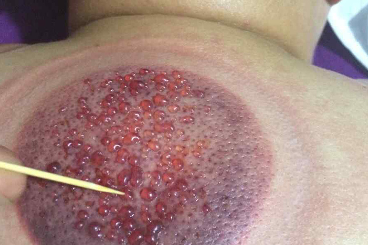 拔罐后罐印黑紫色图