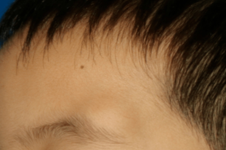 毛发上皮瘤眉毛症状图