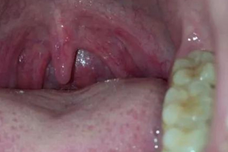 慢性咽炎咽喉血丝图