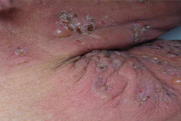 艾滋病腋窝处皮疹图