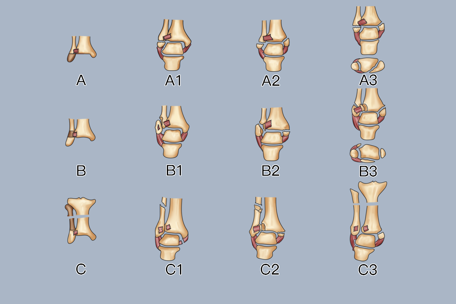 踝关节骨折AO分型