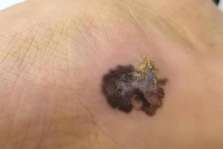 不规则色素痣图 不规则色素痣图
