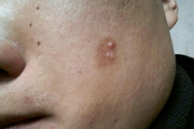 脸上寻常疣初期图 脸上寻常疣初期图