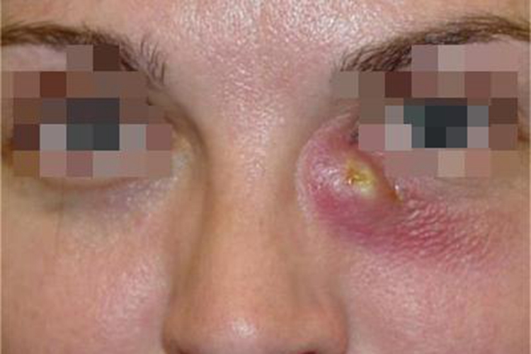 泪囊炎眼部脓包图片