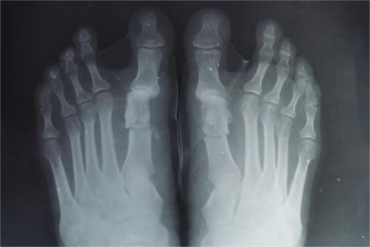 脚掌CT图