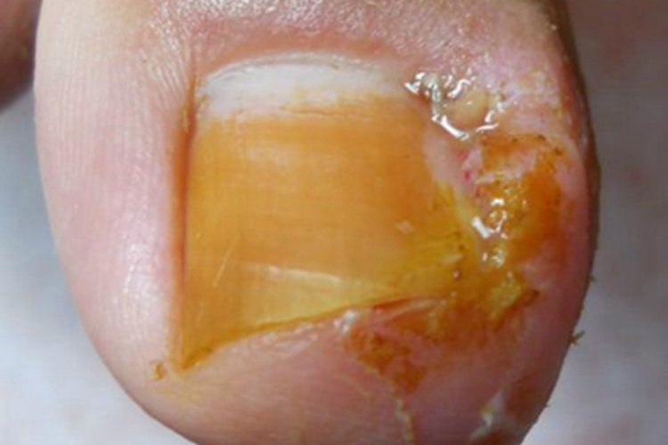 急性甲沟炎脚趾化脓图
