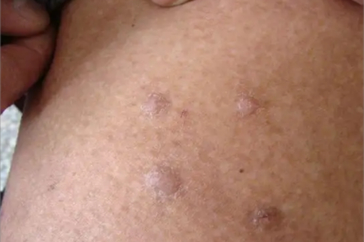 砷角化病疙瘩图