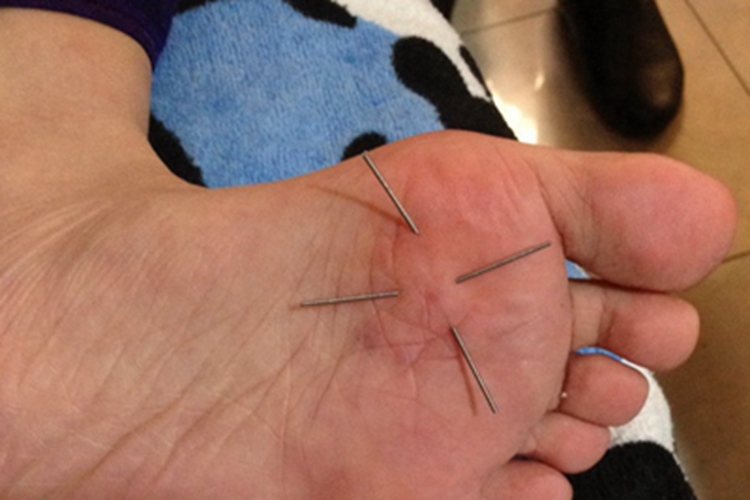 戳伤脚底症状图