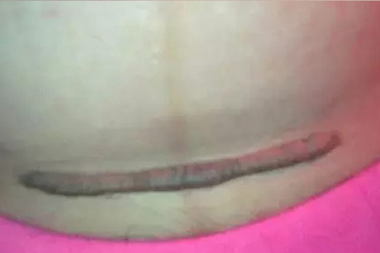 剖腹产疤痕发红增生图