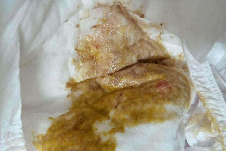 食物蛋白过敏相关性直肠结肠炎图