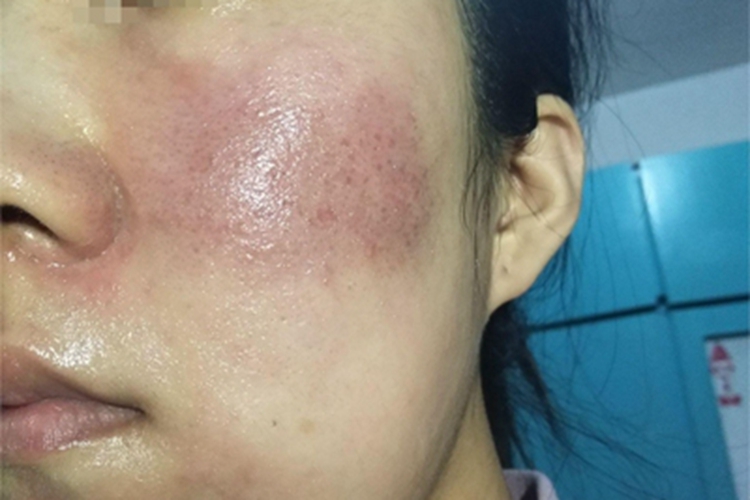 面部皮炎皮肤粗糙图
