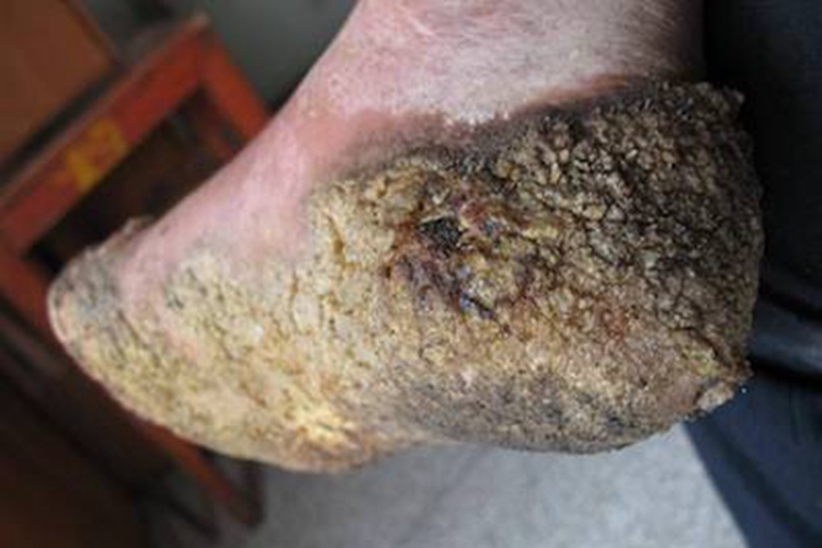 疣状皮肤结核脚底裂纹图