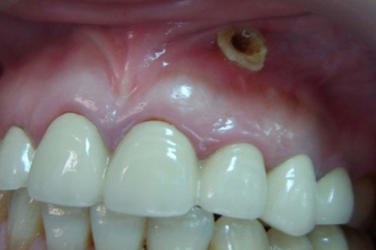 牙龈有洞眼图 牙龈有洞眼图