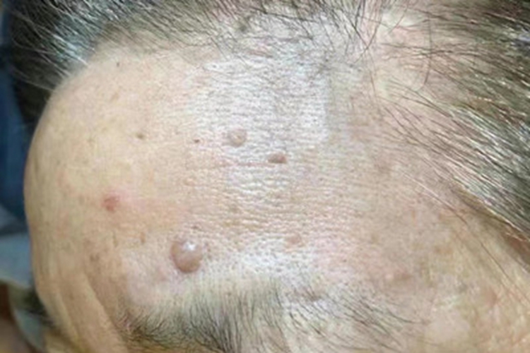 扁平疣额头起浅褐色疙瘩图