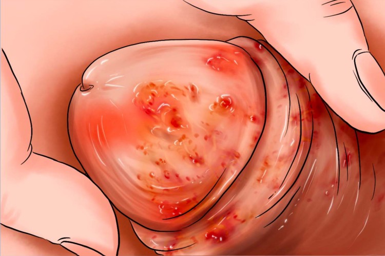 生殖器疱疹阴茎化脓图