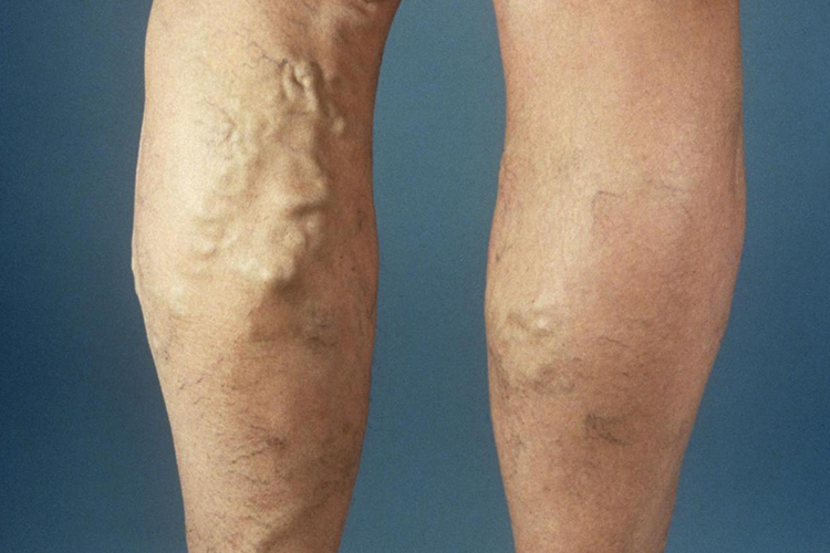 下肢静脉血栓血管曲张图