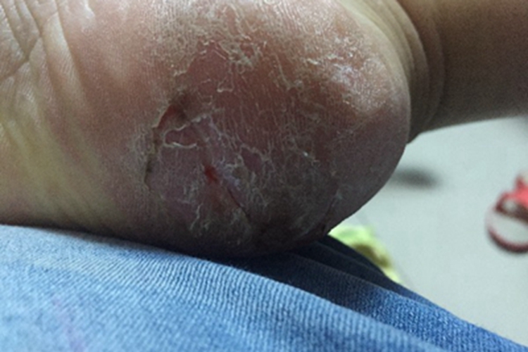 寻常型鱼鳞病脚后跟脱皮图 寻常型鱼鳞病脚后跟脱皮图