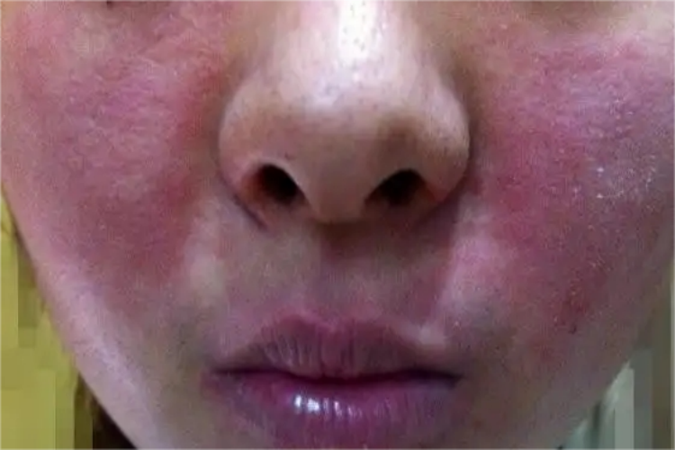 皮肤光敏反应面部红斑图