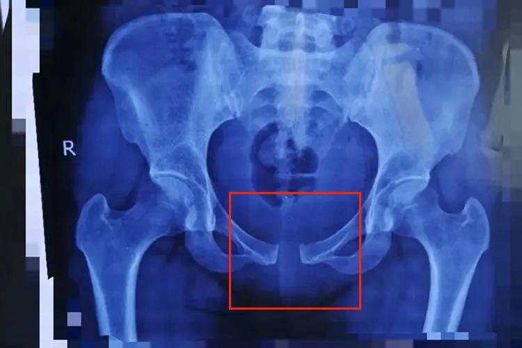 耻骨联合分离图