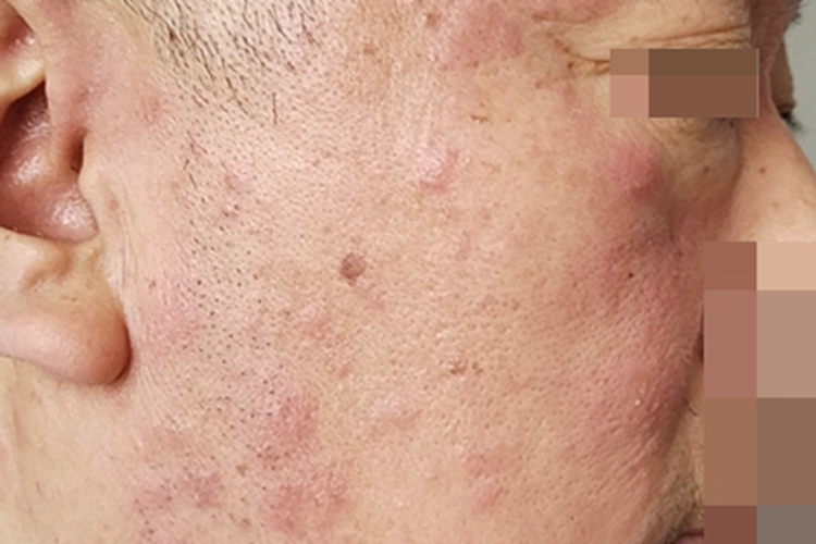 过敏性皮炎面部长红色皮疹图 过敏性皮炎面部长红色皮疹图