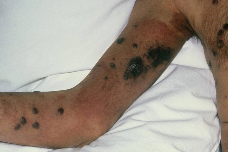 艾滋病卡波西肉瘤图